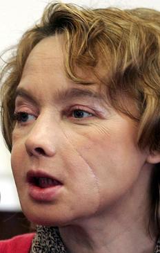 Η Ιζαμπέλ Ντινουάρ, μετά τη μεταμόσχευση